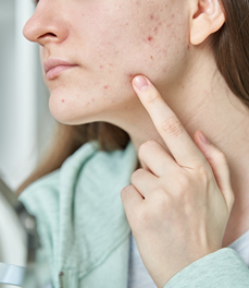Cura acne